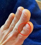 Image result for Bone Spur On Finger