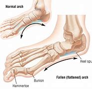 Image result for Arch Collaps Feet