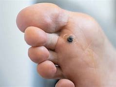 Image result for HPV Plantar Warts