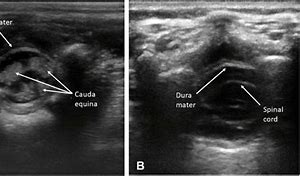 Image result for Transverse Spine