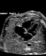 Image result for Abnormal Fetal Heart Ultrasound