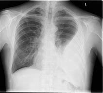 Image result for Empyema Thoracis X-ray