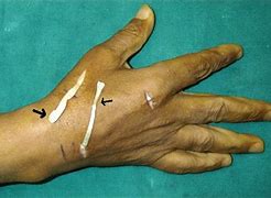 Image result for Thumb Extensor Tendonitis