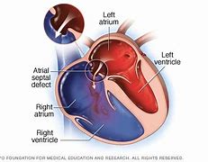 Image result for Atrial Septal Defect Blood Flow