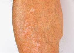 Image result for Dark Pigmentation On Legs