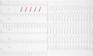 Image result for Polymorphic Wide Complex Tachycardia