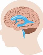 Image result for Hydrocephalus