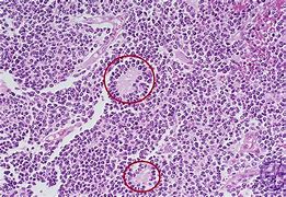 Image result for Neuropil Medulloblastoma