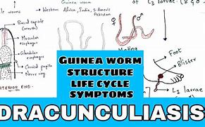 Image result for Dracunculiasis Treatment