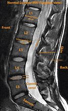 Image result for Lumbar Spine MRI 8Mm