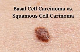 Image result for Squamous and Basal Cell Cancer