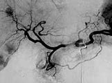 Image result for Tace Ablation