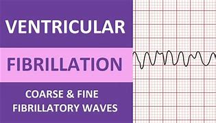 Image result for Course V-fib