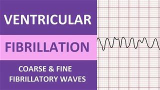 Image result for Ventricular Flutter and Fibrillation