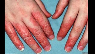 Image result for Eczema On Hands