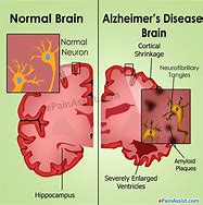 Image result for ALZ Disease