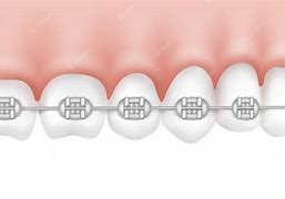 Image result for Fixed Braces Teeth Side View