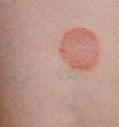 Image result for Small Red Circular Rash On Skin