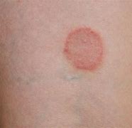 Image result for Raised Circular Lesion On Skin