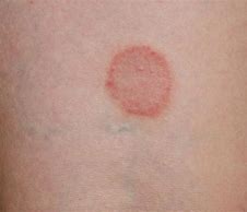 Image result for Circular Rash On Skin