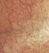 Image result for Atrophy Dermatology