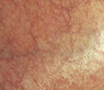 Image result for De Qinjection Atrophy Skin