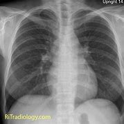 Image result for Miliary Tuberculosis Chest X-ray