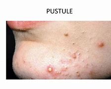 Image result for Pustule Skin Lesion