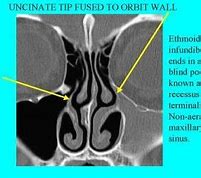 Image result for Infundibulum Nose