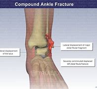 Image result for Compound Fracture Ankle Surgery