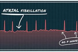 Image result for AFib Heart