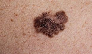 Image result for Melanoma Skin Cancer On Back