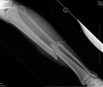 Image result for A Broken Bone