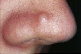 Image result for Pustules On Nose