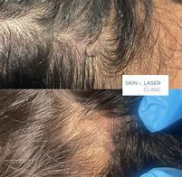 Image result for Trim Skin Lesion