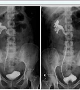 Image result for J-shaped Ureter