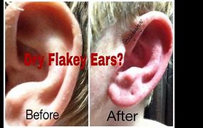 Image result for Dry Ears Disease