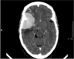 Image result for Small Calcified Meningioma CT Image