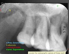 Image result for Pterygoid Plate