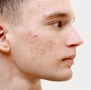 Image result for Acne On Side of Face