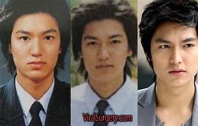 Image result for Lee Min Ki Plastic Surgery