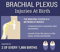 Image result for Brachial Plexus Injury