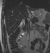 Image result for IRM Abdominal