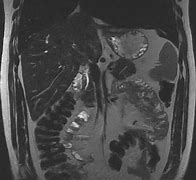 Image result for IRM Abdominale