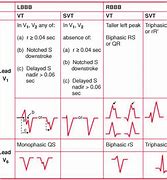 Image result for Polymorphic Wide Complex Tachycardia