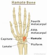 Image result for Capitate Bone Fracture Repair