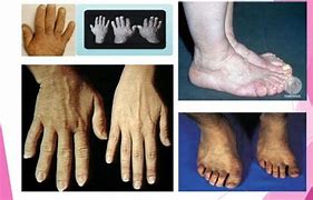 Image result for Acromegaly and Gigantism Documentaries