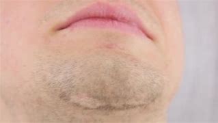 Image result for Scar On Chin