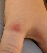 Image result for Spider Bite Pimple