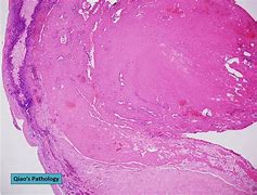 Image result for Organizing Thrombus Histology